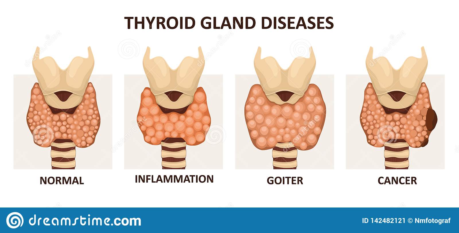 Diseases of the Thyroid Gland